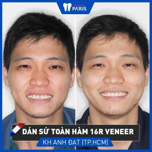 Hình ảnh dán sứ veneer của KH anh Đạt – Ca 71