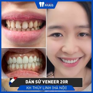 Hình ảnh dán sứ Veneer của KH Thùy Linh – Ca 74