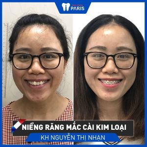 Hình ảnh niềng răng mắc cài kim loại của KH Nguyễn Thị Nhạn – Ca 75