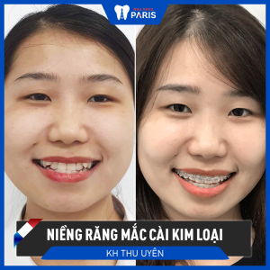 Hình ảnh niềng răng mắc cài kim loại của KH Thu Uyên – Ca 77