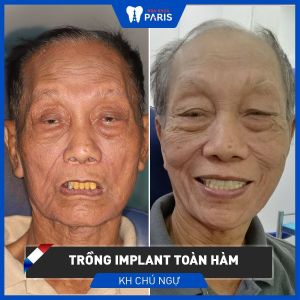 Hình ảnh trồng răng implant toàn hàm của chú Ngự - Ca 79