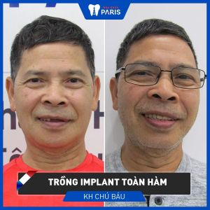 Hình ảnh trồng răng implant của chú Báu – Ca 80
