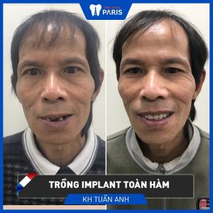 Hình ảnh trồng răng implant của KH Tuấn Anh – Ca 81