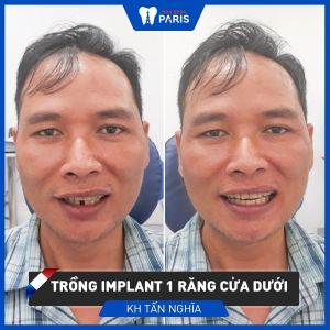 Hình ảnh trồng răng implant của KH Tấn Nghĩa – Ca 82