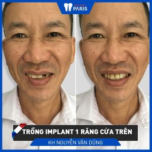 Hình ảnh trồng răng implant của KH Nguyễn Văn Dũng – Ca 84