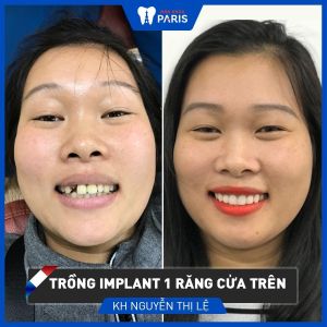 Hình ảnh trồng răng implant của KH Nguyễn Thị Lệ - Ca 85