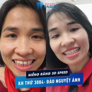Hình ảnh niềng răng 3D Speed của KH Đào Nguyệt Ánh – Ca 87