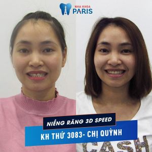 Hình ảnh niềng răng 3D Speed của KH chị Quỳnh – Ca 88
