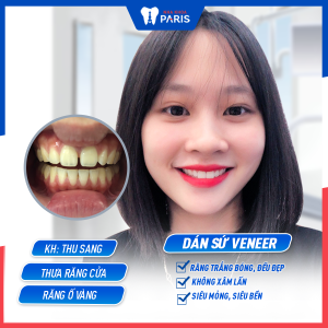 Hình ảnh dán sứ Veneer của KH Thu Sang – Ca 9