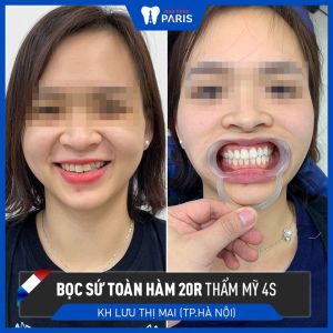 Hình ảnh bọc răng sứ của KH Lưu Thị Mai – Ca 90