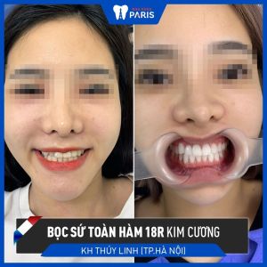 Hình ảnh bọc sứ toàn hàm 18 răng kim cương của KH Thúy Linh – Ca 91