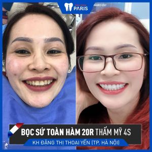 Hình ảnh bọc răng sứ của KH Đặng Thị Thoại Yến – Ca 97