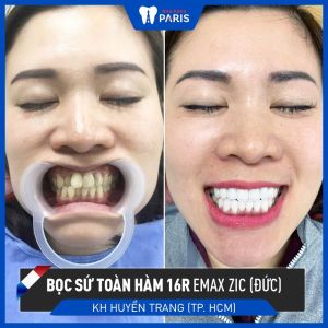 Hình ảnh bọc răng sứ của KH Huyền Trang – Ca 98