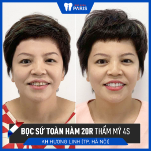 Hình ảnh bọc răng sứ của KH Hương Linh – Ca 99