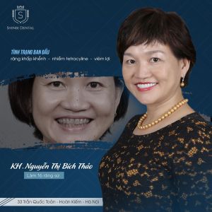 Hình ảnh bọc răng sứ của KH Nguyễn T. Bích Thảo- Viện CN Nha khoa Thẩm mỹ Shinbi- ca 10