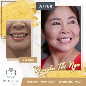 Hình ảnh bọc răng sứ của KH Nguyễn Thị Nga – Viện CN Nha khoa Thẩm mỹ Shinbi – Ca 11
