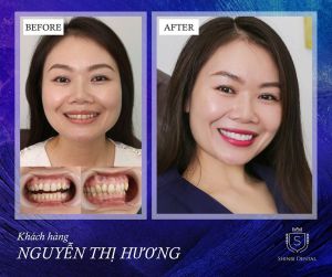 Hình ảnh bọc răng sứ của chị Thu Hương – Viện CN Nha khoa Thẩm mỹ Shinbi – Ca 14