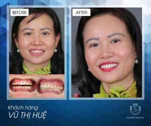 Hình ảnh bọc răng sứ của KH Vũ Thị Huệ - Viện CN Nha khoa Thẩm mỹ Shinbi – Ca 16