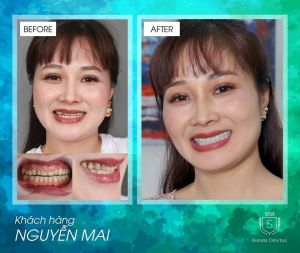 Hình ảnh bọc răng sứ của KH Nguyễn Mai – Viện CN Nha khoa Thẩm mỹ Shinbi – Ca 17