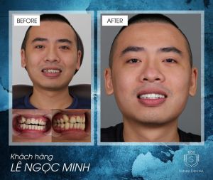 Hình ảnh bọc răng sứ của KH Lê Ngọc Minh – Viện CN Nha khoa Thẩm mỹ Shinbi – Ca 18
