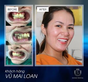 Hình ảnh bọc răng sứ và trồng răng implant của KH Vũ Mai Loan – Viện CN Nha khoa Thẩm mỹ Shinbi – ca 19