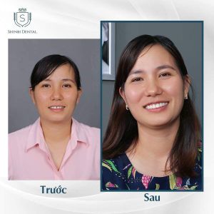 Hình ảnh bọc răng sứ của KH Mai Thị Xuyến – Viện CN Nha khoa Thẩm mỹ Shinbi – Ca 21