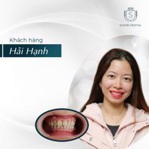 Hình ảnh bọc răng sứ của KH Hải Hạnh – Viện CN Nha khoa Thẩm mỹ Shinbi – Ca 22