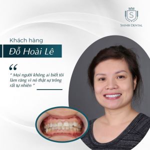 Hình ảnh bọc răng sứ của KH Đỗ Hoài Lê – Viện CN Nha khoa Thẩm mỹ Shinbi – Ca 23