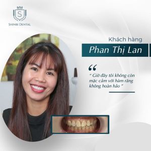 Hình ảnh bọc răng sứ của KH Phan Thị Lan – Viện CN Nha khoa Thẩm mỹ Shinbi – Ca 24