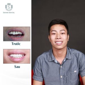Hình ảnh bọc răng sứ của KH Đoàn Văn Tuấn Anh – Viện CN Nha khoa Thẩm mỹ Shinbi – Ca 25