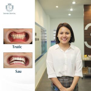 Hình ảnh dán sứ Veneer của KH Hà Thị Thu – Viện CN Nha khoa Thẩm mỹ Shinbi – Ca 26