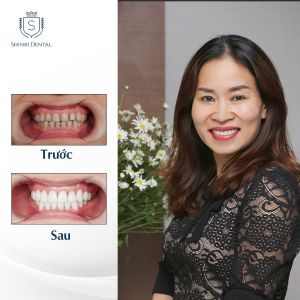 Hình ảnh bọc răng sứ của KH Cao Thanh Huyền – Viện CN Nha khoa Thẩm mỹ Shinbi – Ca 27