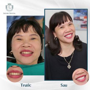 Hình ảnh bọc răng sứ của KH Phạm Thị Ngân – Viện CN Nha khoa Thẩm mỹ Shinbi – Ca 28