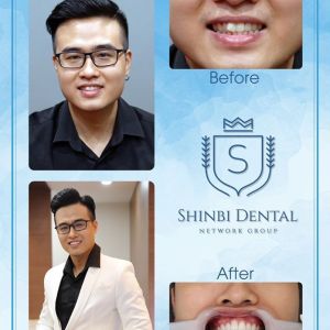 Hình ảnh dán sứ Veneer của KH Nguyễn Hữu Minh – Viện CN Nha khoa Thẩm mỹ Shinbi – Ca 5
