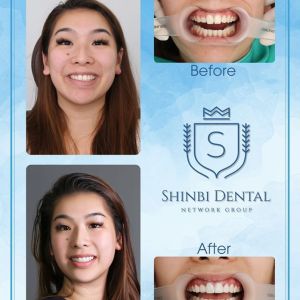 Hình ảnh dán sứ Veneer của Lê Thị Trang – Viện CN Nha khoa Thẩm mỹ Shinbi – Ca 6