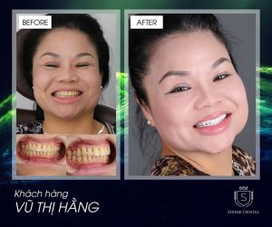 Hình ảnh bọc răng sứ của KH Vũ Thị Hằng – Viện CN Nha khoa Thẩm mỹ Shinbi – Ca 15