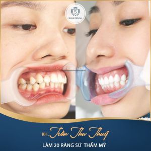 Hình ảnh niềng răng – Viện CN Nha khoa Thẩm mỹ Shinbi – ca 2