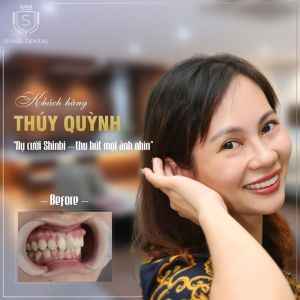 Hình ảnh bọc răng sứ của KH Thúy Quỳnh – Viện CN Nha khoa Thẩm mỹ Shinbi – Ca 9