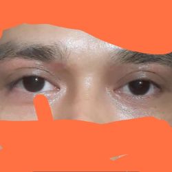 Nâng cung chân mày bị sẹo và hai mí không đều?