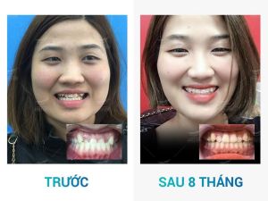 Hình ảnh niềng răng invisalign của KH Minh Phương – Nha khoa Smile one – Ca 1