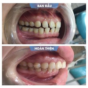 Hình ảnh niềng răng invisalign của KH Vũ Thị Hoài My – Nha khoa Smile one – Ca 10