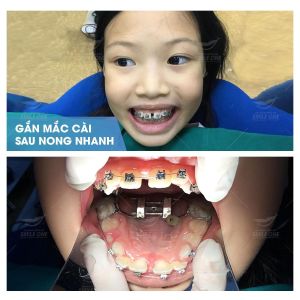 Hình ảnh niềng răng mắc cài của KH Lưu Khánh Chi – Nha khoa Smile one – Ca 11