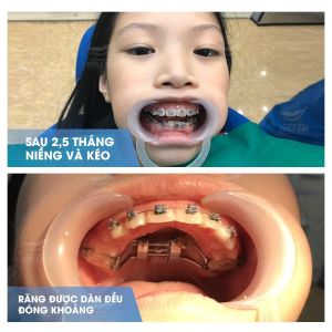 Hình ảnh niềng răng mắc cài của KH Lưu Khánh Chi – Nha khoa Smile one – Ca 11