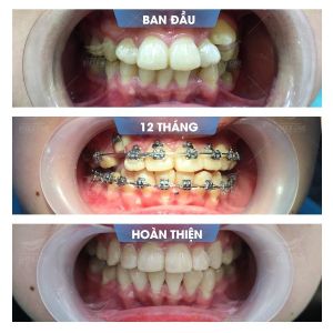 Hình ảnh niềng răng mắc cài của bạn Ngọc – Nha khoa Smile one – Ca 12