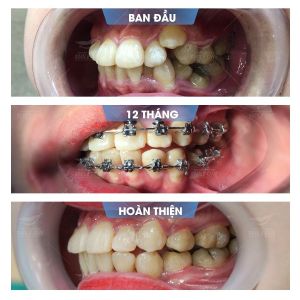 Hình ảnh niềng răng mắc cài của bạn Ngọc – Nha khoa Smile one – Ca 12