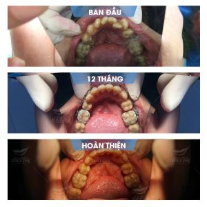 Hình ảnh niềng răng mắc cài của bạn Ngọc – Nha khoa Smile one – Ca 12