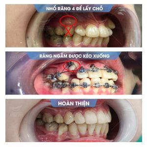 Hình ảnh niềng răng mắc cài của bạn Ngọc – Nha khoa Smile one – Ca 12