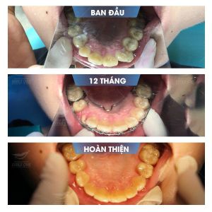 Hình ảnh niềng răng mắc cài của bạn Ngọc – Nha khoa Smile one – Ca 12