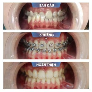 Hình ảnh niềng răng mắc cài của bạn Tuyết – Nha khoa Smile one – Ca 13