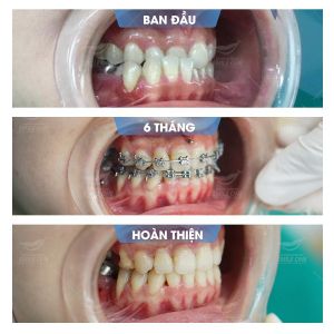 Hình ảnh niềng răng mắc cài của bạn Tuyết – Nha khoa Smile one – Ca 13